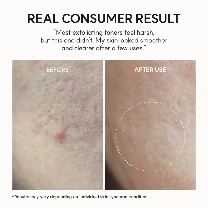 تونر لایه‌بردار و پاکسازی‌کننده آرنسیا Arencia Eraser Shot Glycolic Acid Exfoliator حاوی 10٪ گلیکولیک اسید، سالیسیلیک اسید و هیالورونیک اسید حجم 200 میل - Image 8